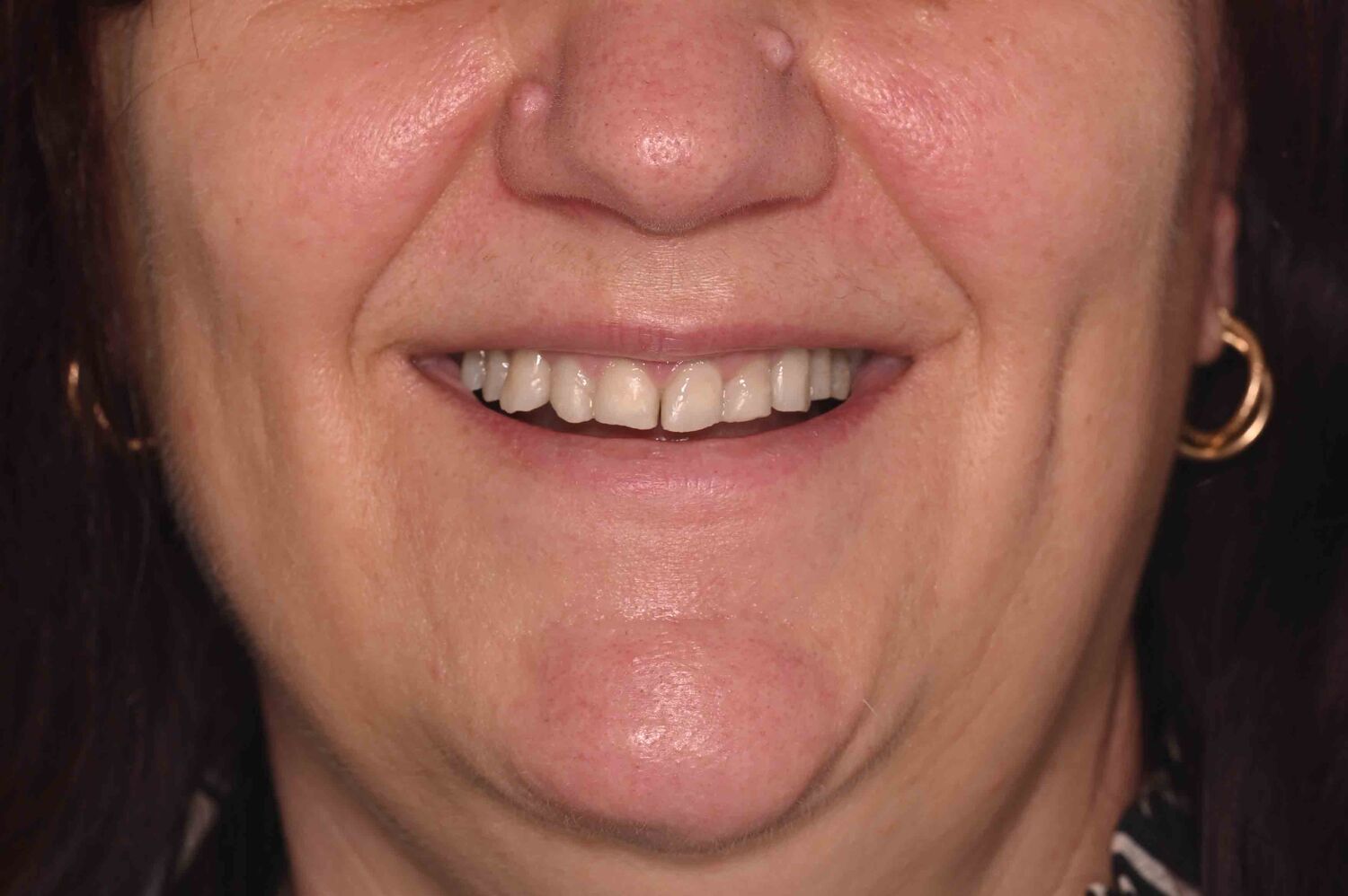 Pacient Clinica Dr. Alin Odor - Rezultat Implantologie